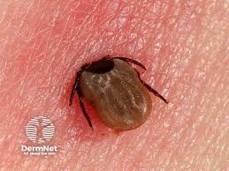 Image result for infected tick bite