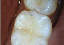 Bacteria produce acid as a byproduct. Cavity Symptoms Treatment In Allentown Pa Green Hills Dentistry