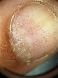 Image result for Nail Pitting