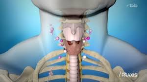Knoten in der schilddrüse (glandula thyroidea), oder schilddrüsenvergrößerungen sind äußerst häufig anzutreffen. Nachgefragt Schilddruse Wieder Volle Energie Aus Dem Hals Rbb