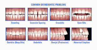This sounds quite scary, but it is a normal way to fix an underbite. Common Orthodontic Problems