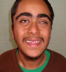 Facial appearance of the patient.