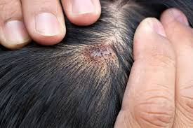 Image result for Cyst