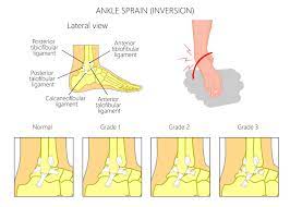 Instability and grade of sprain  edit source ligament sprains can be of the following grades: Sprained Ankle Are They All The Same Evolve Sports Physio