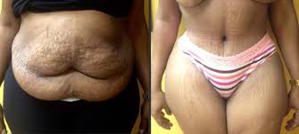 This affordable tummy tuck promotional offer at our clinic in miami, florida includes physician cost, surgery room cost, anesthesia, anesthesiologist, labs, and 1 year of follow up visits. Plus Size Tummy Tuck Everything You Need To Know