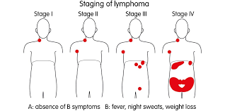 Image result for Lymphoma