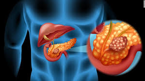 People usually have no symptoms until the cancer has already spread to other organs. Diabetes After 50 Could Be Early Sign Of Pancreatic Cancer Cnn