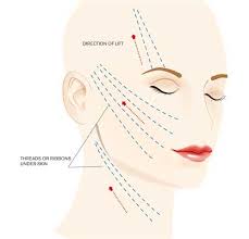 Maybe you would like to learn more about one of these? Mini Facelift Thread Lift Procedure London Uk