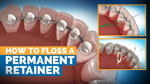 Quick explorations always have the chance to get the max minion from the 18 hour ventures as long as your retainer is above the stat or ilvl requirement to unlock the highest item pool. Invisalign Retainers What To Expect After Treatment Premier Orthodontics