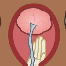 Duration of third stage of labour was shorter in women with epidural analgesia requiring manual removal of placenta. Procedure For Manual Removal Of Placenta Demonstration Maternity Foundation