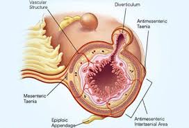 Diverticulitis Diverticulosis Symptoms Diet Treatment