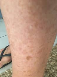 Image result for liver spots on legs