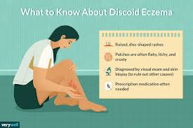 We did not find results for: Discoid Eczema Symptoms Causes Diagnosis Treatment And Coping