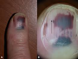 Image result for Acral lentiginous melanoma nail