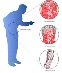 Adhesions Scar Tissue Guide To Adhesions