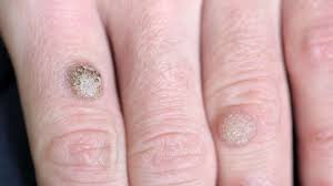 1 can skin cancer or melanoma arise from the cells of a seborrheic keratosis?. Seborrheic Keratosis Symptoms Causes Treatments Clear Skin Clinic