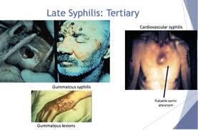 Image result for Cardiovascular Syphilis