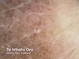 Image result for Lichen Simplex Chronicus