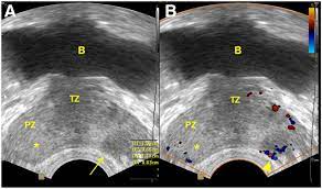 17.01.2020 · advanced prostate cancer can cause signs and symptoms including: Utility Of Ultrasound In The Diagnosis Treatment And Follow Up Of Prostate Cancer State Of The Art Journal Of Nuclear Medicine