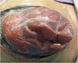 Another advantage to the bogota bag, is that the abdominal contents can be visually inspected. Bogota Bag For Pediatric Open Abdomen Sciencedirect