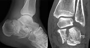Image result for Calcaneus
