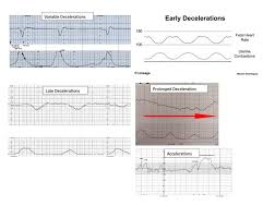 Image result for Late Deceleration