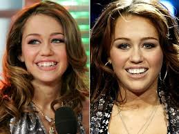 R/extramile, r/celebnsfw, r/downblouse, r/jerkofftocelebs, r/upskirt, r/celebritypussy, r/watchitfortheplot. Celebrity Veneers Celebrities With Veneers Before And After Celebrity Teeth Celebrities With Veneers Perfect Smile