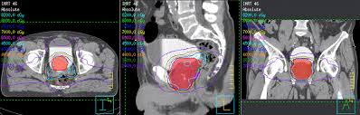 Image result for Intensity-Modulated Radiation Therapy