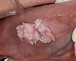 Image result for white cancer on tongue)