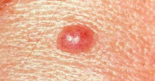 A visual guide to identifying warning signs on your body. Skin Cancer Or Mole How To Tell Cbs News