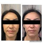 Buccal Fat Removal Albuquerque NM, D. Eric Tuggle, D.D.S.