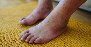 Image result for diabetic toes