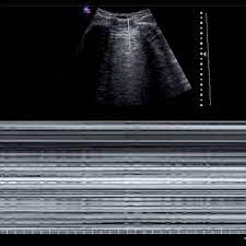 Als fachkrankenhaus und akutklinik behandeln wir menschen im alter von 18 bis über 70 jahren mit einer psychosomatischen diagnose. Abb 3 9 M Mode Fehlendes Lungengleiten Pneumothorax Moglich Download Scientific Diagram