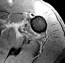 Chia sẻ chi tiết hình ảnh về bầu đức hagl không phải ai cũng biết. Hagl Lesion Radsource