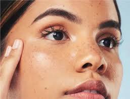 How to Remove Dark Spots - Expert Tips ...