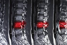 Image result for Vertebral Compression Fracture