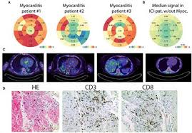 Myocarditis may be a more common prelude to dilated cardiomyopathy than was once believed. Frontiers Early Detection Of Checkpoint Inhibitor Associated Myocarditis Using 68ga Fapi Pet Ct Cardiovascular Medicine