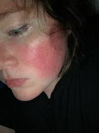 Fundraiser for Heather Kughn by Sheena Sharapata : Donate to Heather for  DBS Surgery for Anesthesia Dolorosa