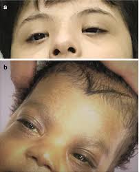 Appearance of epicanthal folds with other eye and lens abnormality and flattened nose confirm the presence of fetal alcohol. Childhood Neuro Ophthalmic Disorders Springerlink