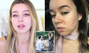 As of 2021, she is around 28 years old. Youtube Star Sierra Furtado Reveals How She Beat Her Acne Daily Mail Online