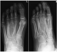 «skip» metastases in osteosarcoma // cancer. Low Grade Central Osteosarcoma Of The Metatarsal Bone A Clinicopathological Immunohistochemical Cytogenetic And Molecular Cytogenetic Analysis Anticancer Research