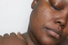 Image result for Postinflammatory Hyperpigmentation