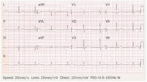 Image result for Left Ventricular Outflow Obstruction