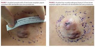 Image result for Dermatofibrosarcoma Protuberans