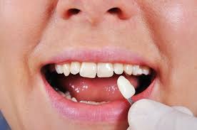 Use a soft bristle toothbrush. Porcelain Veneers Orlando Fl Koyfman Dental Cosmetic Dentistry