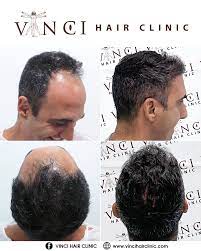 Hair Transplant Results Take Some Time To Develop But It Is Well Worth The Wait Hair Transplant Results Hair Transplant Hair Clinic
