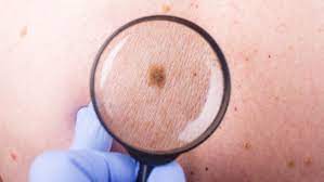 Squamous cell carcinoma is the second most common type of skin cancer. Five Little Known Things About Skin Cancer Lluh News
