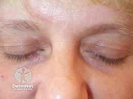 Image result for xanthelasma of eyelid
