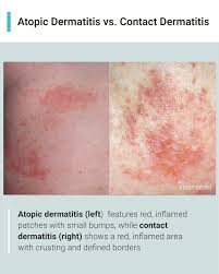 Image result for contact dermatitis