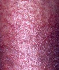Image result for dermatitis contacta children